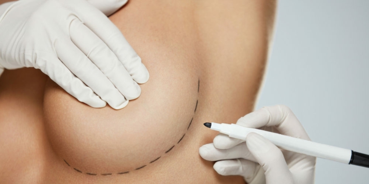 chirurgie plastique-implants-seins-silicone
